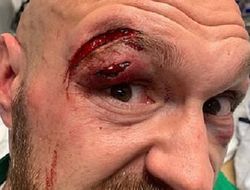 фото - Катмен Тайсона Фьюри: Это самое худшее рассечение, которое я видел