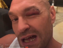 фото - Тайсон Фьюри: «Мне наложили 11 швов, никогда такого не было»