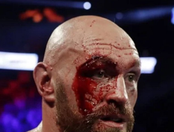 фото - Сколько времени понадобится Фьюри, чтобы залечить рассечение? Мнение Льюиса