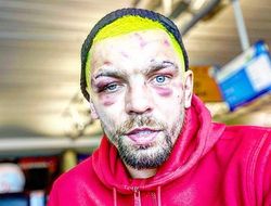 фото - Редкача жёстко покарали за кусание Гарсии