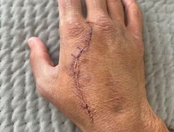 фото - Элиминатор Уорд-Холматов, оппонент Лары, Кордина показал руку после операции